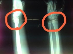 コーレス骨折（若木骨折）の早期回復はエコルスタ整骨院の酸素カプセル療法.jpg
