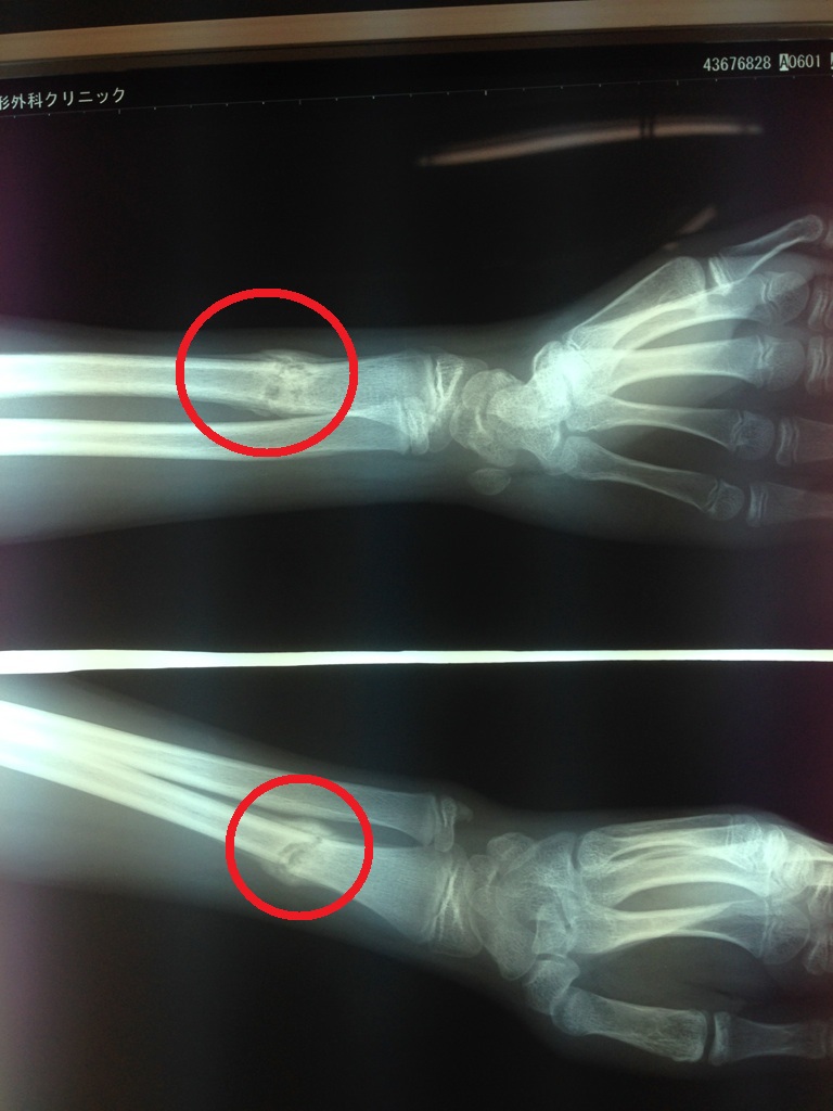 橈骨下端部骨折 酸素カプセル ｎｅｕｂｏｘ療法の症例 エコルスタはりきゅう整骨院 骨折 痛み 怪我は身体を正しく使える様にして治す 千葉県市川市南行徳
